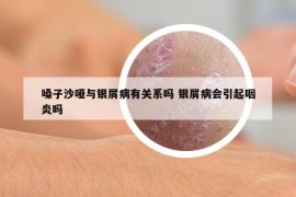 嗓子沙啞與銀屑病有關(guān)系嗎 銀屑病會(huì)引起咽炎嗎