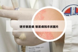 硬幣銀屑病 銀屑病錢幣狀圖片