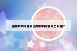 副銀屑病綜合癥 副銀屑病綜合癥怎么治療