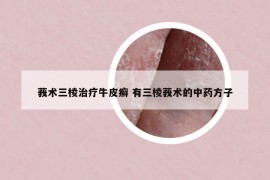 莪術(shù)三棱治療牛皮癬 有三棱莪術(shù)的中藥方子