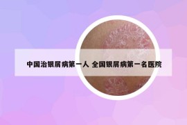 中國治銀屑病第一人 全國銀屑病第一名醫(yī)院