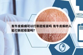有牛皮癬病可以打新冠疫苗嗎 有牛皮癬的人能打新冠疫苗嗎?