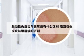 脂溢性頭皮炎與銀屑病有什么區(qū)別 脂溢性頭皮炎與銀屑病的區(qū)別