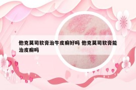 他克莫司軟膏治牛皮癬好嗎 他克莫司軟膏能治皮癬嗎