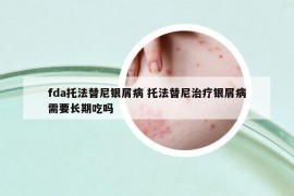 fda托法替尼銀屑病 托法替尼治療銀屑病需要長期吃嗎