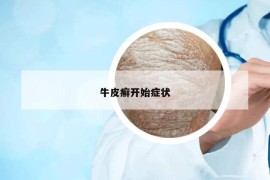 牛皮癬開(kāi)始癥狀