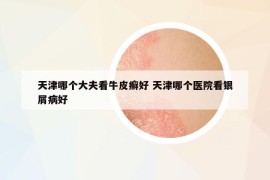 天津哪個大夫看牛皮癬好 天津哪個醫(yī)院看銀屑病好