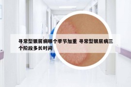 尋常型銀屑病哪個季節(jié)加重 尋常型銀屑病三個階段多長時間