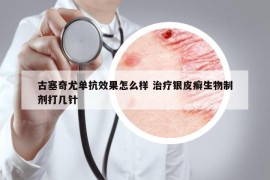 古塞奇尤單抗效果怎么樣 治療銀皮癬生物制劑打幾針