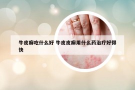 牛皮癬吃什么好 牛皮皮癬用什么藥治療好得快