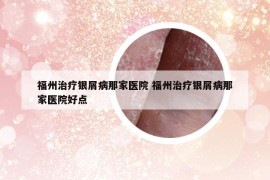 福州治療銀屑病那家醫(yī)院 福州治療銀屑病那家醫(yī)院好點(diǎn)