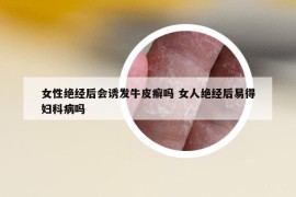 女性絕經(jīng)后會(huì)誘發(fā)牛皮癬嗎 女人絕經(jīng)后易得婦科病嗎