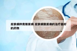 皮膚病種類銀屑病 皮膚病銀屑病的治療最好的藥物