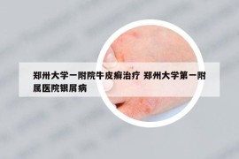 鄭卅大學(xué)一附院牛皮癬治療 鄭州大學(xué)第一附屬醫(yī)院銀屑病