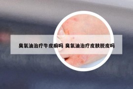臭氧油治療牛皮癬嗎 臭氧油治療皮膚脫皮嗎