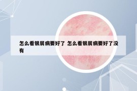 怎么看銀屑病要好了 怎么看銀屑病要好了沒有