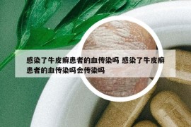 感染了牛皮癬患者的血傳染嗎 感染了牛皮癬患者的血傳染嗎會傳染嗎
