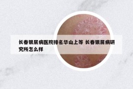 長春銀屑病醫(yī)院排名華山上等 長春銀屑病研究所怎么樣