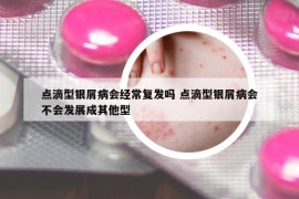 點(diǎn)滴型銀屑病會(huì)經(jīng)常復(fù)發(fā)嗎 點(diǎn)滴型銀屑病會(huì)不會(huì)發(fā)展成其他型