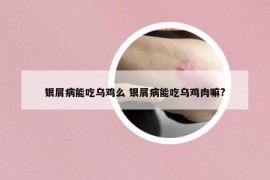 銀屑病能吃烏雞么 銀屑病能吃烏雞肉嘛?