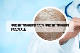 中醫(yī)治療銀屑病的好處方 中醫(yī)治療銀屑病的好處方大全