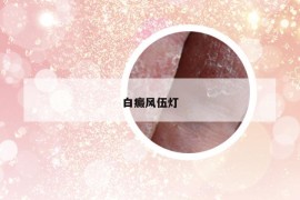 白癜風(fēng)伍燈