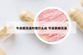 牛皮癬洗澡時用什么水 牛皮膚癬洗澡