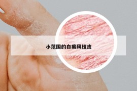 小范圍的白癜風(fēng)植皮