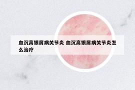 血沉高銀屑病關(guān)節(jié)炎 血沉高銀屑病關(guān)節(jié)炎怎么治療