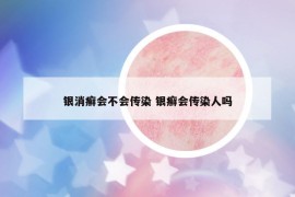 銀消癬會不會傳染 銀癬會傳染人嗎