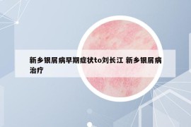 新鄉(xiāng)銀屑病早期癥狀to劉長江 新鄉(xiāng)銀屑病治療