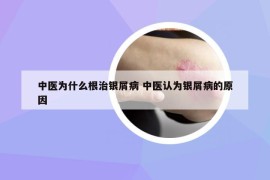中醫(yī)為什么根治銀屑病 中醫(yī)認為銀屑病的原因