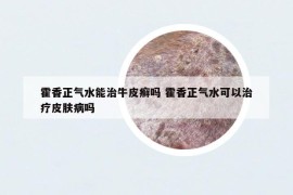 霍香正氣水能治牛皮癬嗎 霍香正氣水可以治療皮膚病嗎
