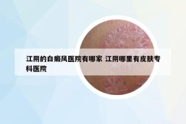 江陰的白癜風醫(yī)院有哪家 江陰哪里有皮膚?？漆t(yī)院