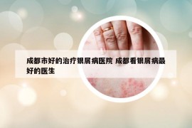成都市好的治療銀屑病醫(yī)院 成都看銀屑病最好的醫(yī)生