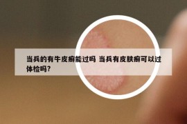 當(dāng)兵的有牛皮癬能過嗎 當(dāng)兵有皮膚癬可以過體檢嗎?