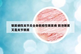 銀屑病性關(guān)節(jié)炎全身膿皰性銀屑病 膿泡銀屑又是關(guān)節(jié)銀屑