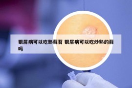 銀屑病可以吃熟蒜苔 銀屑病可以吃炒熟的蒜嗎