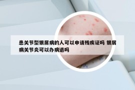 患關(guān)節(jié)型銀屑病的人可以申請殘疾證嗎 銀屑病關(guān)節(jié)炎可以辦病退嗎