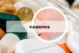 牛皮癬如何養(yǎng)生