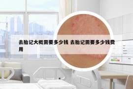 去胎記大概需要多少錢 去胎記需要多少錢費(fèi)用
