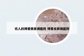 坑人的博愛銀屑病醫(yī)院 博愛皮膚病醫(yī)院