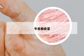 牛皮癬痰濕