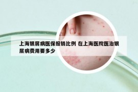 上海銀屑病醫(yī)保報銷比例 在上海醫(yī)院醫(yī)治銀屑病費(fèi)用要多少