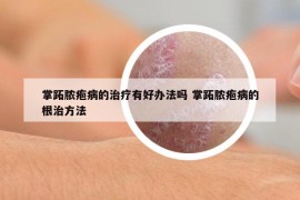 掌跖膿皰病的治療有好辦法嗎 掌跖膿皰病的根治方法