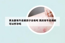 男女都有牛皮癬孩子會(huì)有嗎 男的有牛皮病癬可以懷孕嗎