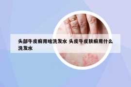 頭部牛皮癬用啥洗發(fā)水 頭皮牛皮膚癬用什么洗發(fā)水