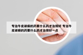 專(zhuān)治牛皮頑癬的藥要什么藥才治得好 專(zhuān)治牛皮頑癬的藥要什么藥才治得好一點(diǎn)