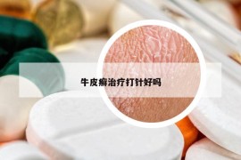 牛皮癬治療打針好嗎