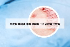 牛皮癬滋潤(rùn)油 牛皮膚癬用什么潤(rùn)膚霜比較好